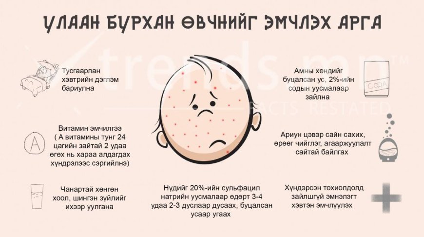 Улаан бурхан өвчин